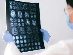 Can Benfotiamine (Vitamin B1/Thiamine) Slow Down Early Alzheimer’s Disease? 